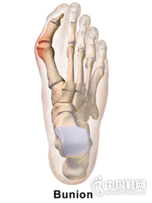 ��Ĵ���ף���̷���Ĵ�ⷭ���Σ����߸�ЬΪŮ�Ի�����ֱ��ԭ��֮һ